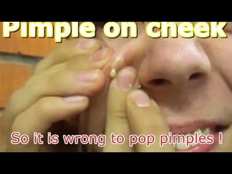 Pimple on cheek. So it is wrong to pop pimples AAHC