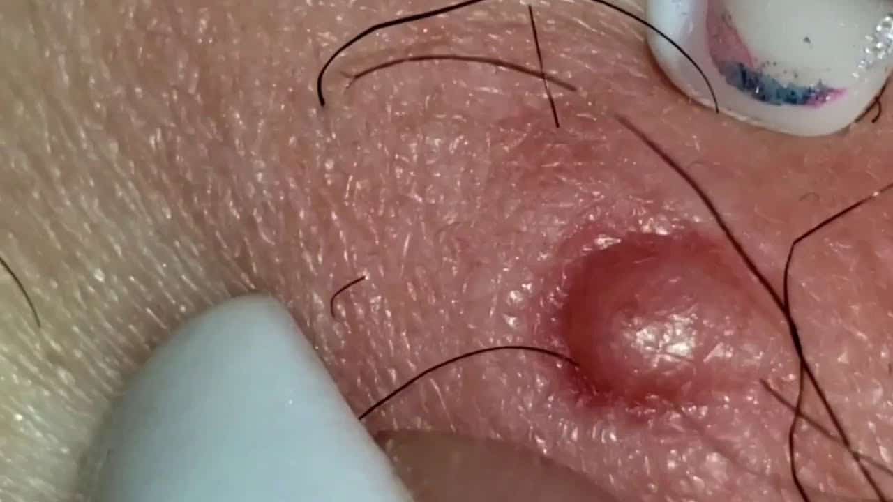 Pimple Pop on the back!