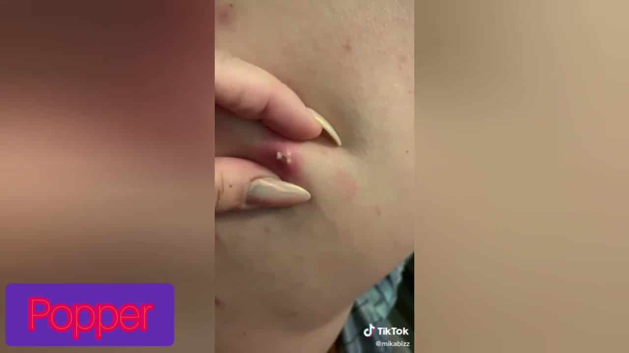 Pimple Popped From Back