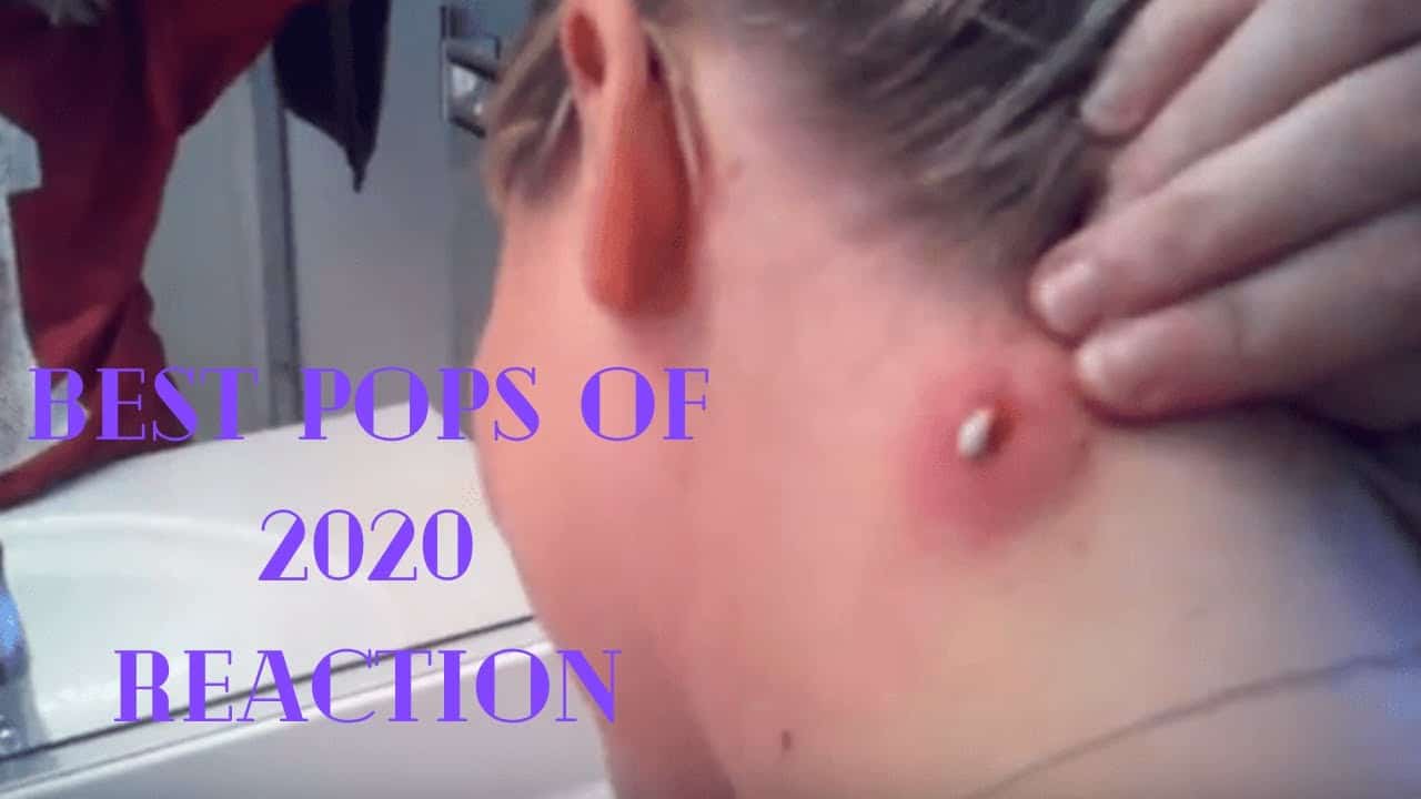 Pimple Popper 2020 | Pimple Popping 2020 Compilation | *Must Watch *