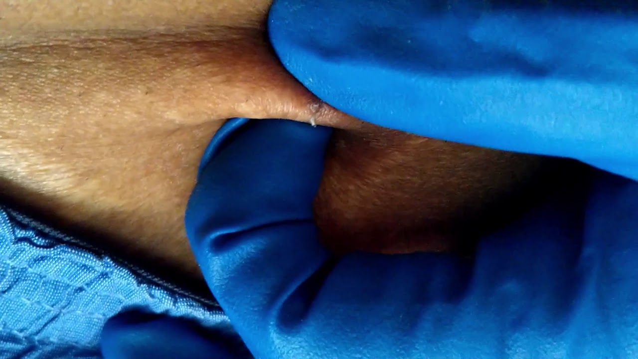 – Pimple Popper #pimple #popping
