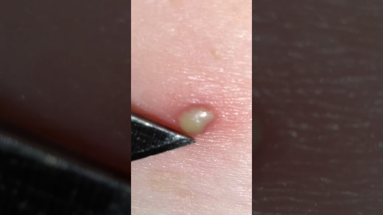PIMPLE POPPING 1