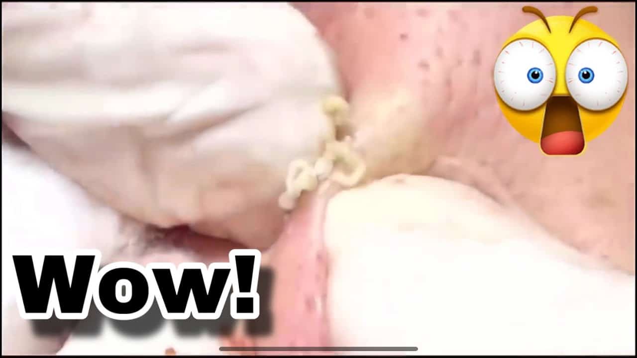PIMPLE POPPING #1 – EXTREMELY SATISFYING!