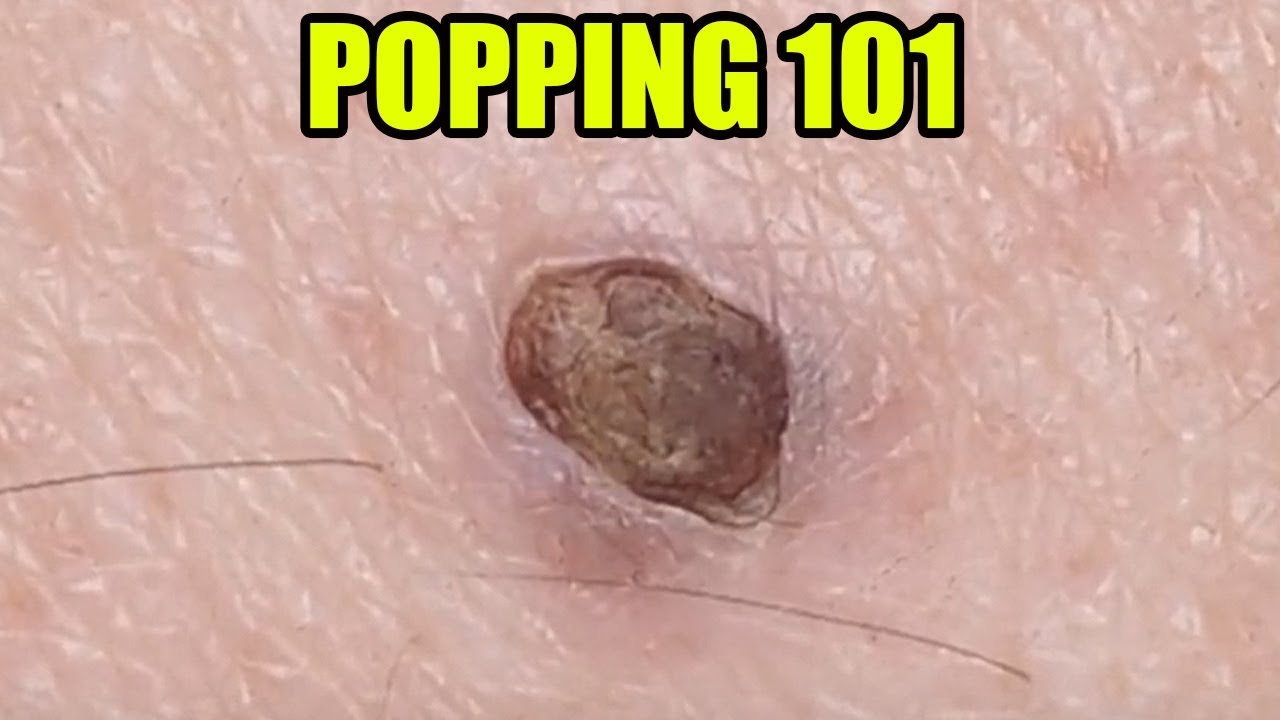 Pimple Popping 101; Watson's Blackheads & Cysts