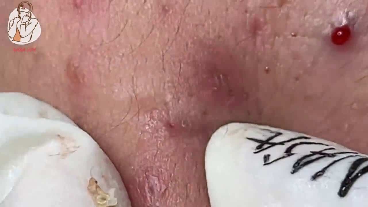 pimple popping 2