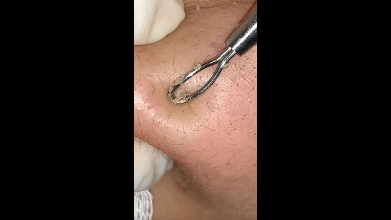 Pimple Popping