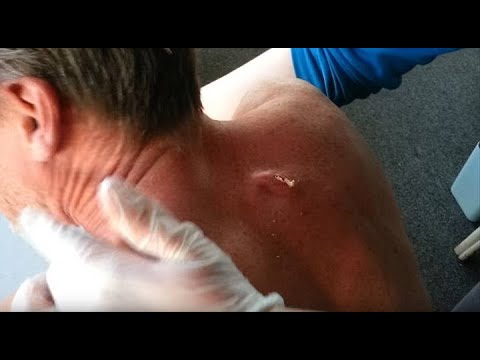 Pimple popping 2016 Best eight