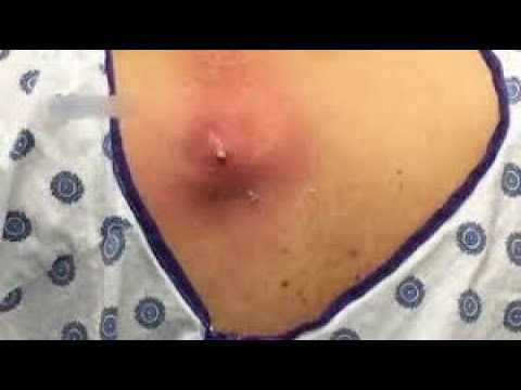 PIMPLE POPPING 2017 TOP EIGHT