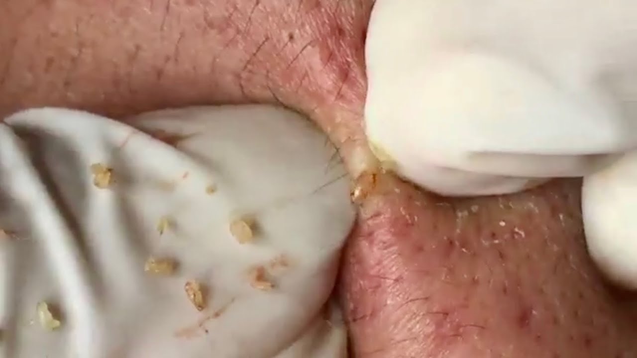 ? Pimple Popping 2020| acne extraction full face| Blackheads Removal| Acne removal|Acne treatment