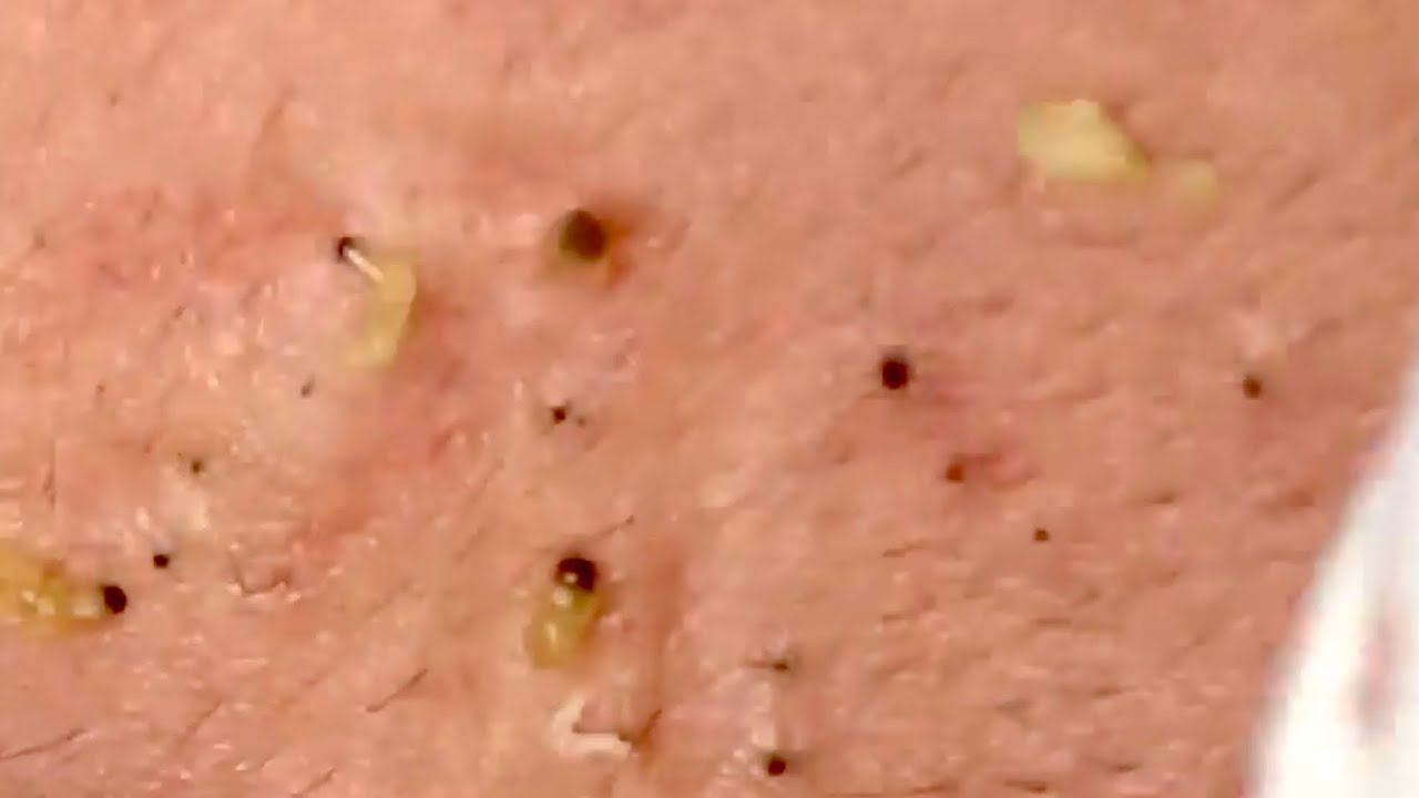 Pimple Popping 2020 HOT??| Blackheads extraction | Blackheads removal| Acne removal|Acne treatment