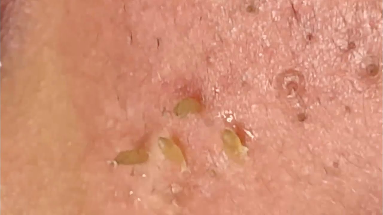 ? Pimple Popping 2020 New| Blackheads extraction| Blackheads removal| Acne removal|Acne treatment