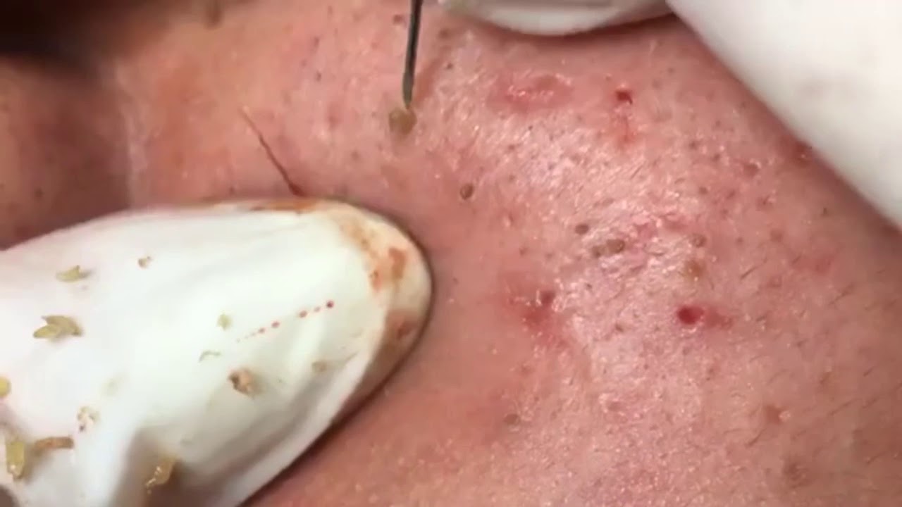 ? Pimple Popping 2020 NEW | Blackheads extraction| Blackheads removal| Acne removal|Acne treatment