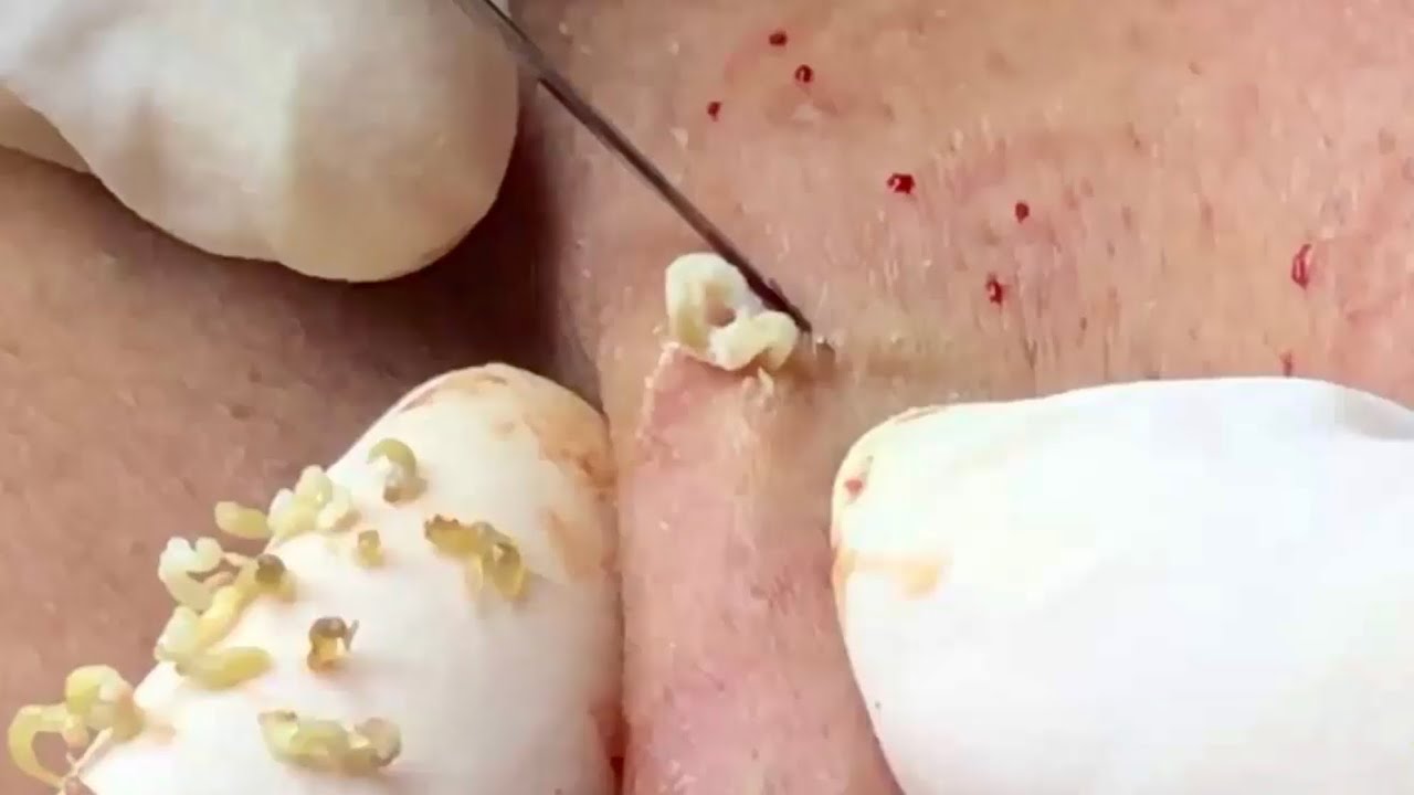? Pimple Popping 2020| Super pimple popping acne | Blackheads Removal| Acne removal|Acne treatment