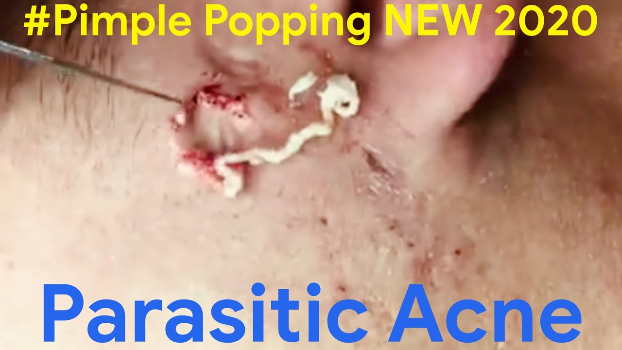 Pimple Popping 2020 Video #05| Blackheads, Whiteheads & Inflamed removal acne treatment