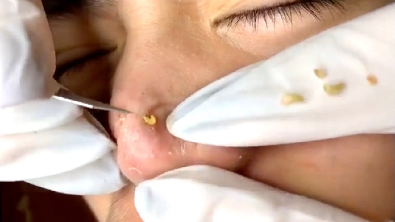 Pimple Popping 2020 Video #06| Blackheads, Whiteheads & Inflamed removal acne treatment