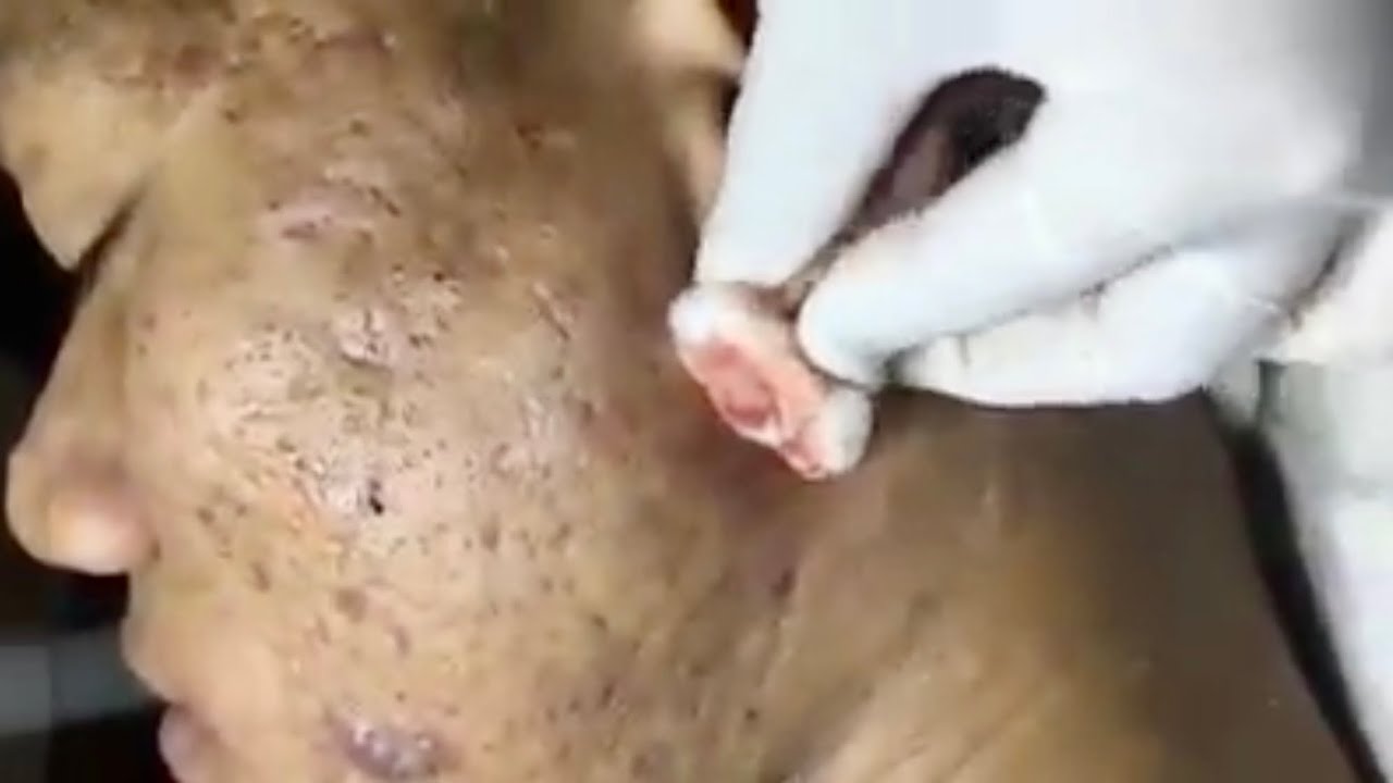 Pimple Popping 2020 Video #26| Blackhead removal, Whitehead removal, Inflamed removal acne treatment
