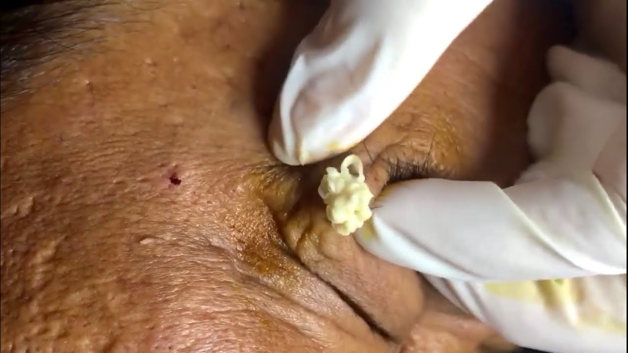 ? Pimple Popping 2020 Video| Big acne in eye shoots out| Blackheads removal| Acne treatment