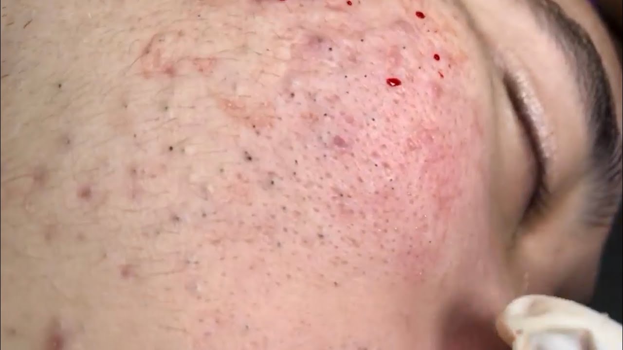 ? Pimple Popping 2020 Video| Blackheads full face| Blackheads removal| Acne removal|Acne treatment