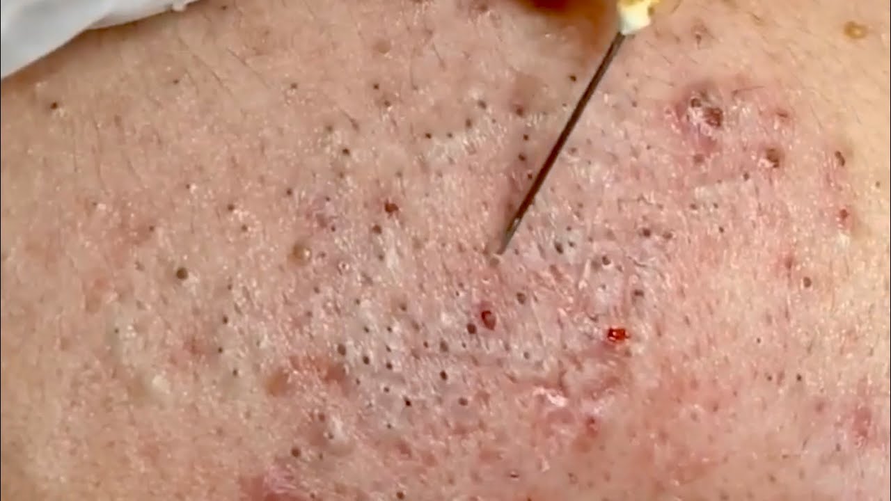 ? Pimple Popping 2020 Video| Blackheads extraction| Blackheads removal| Acne removal|Acne treatment