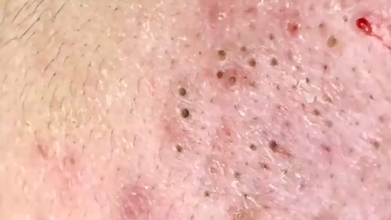 ? Pimple Popping 2020 Video| blackheads extraction| Blackheads removal| Acne removal|Acne treatment