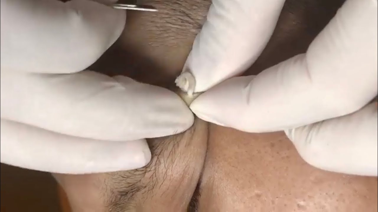 ? Pimple Popping 2020 Video| Removal acne in eye| Blackheads removal| Acne removal|Acne treatment