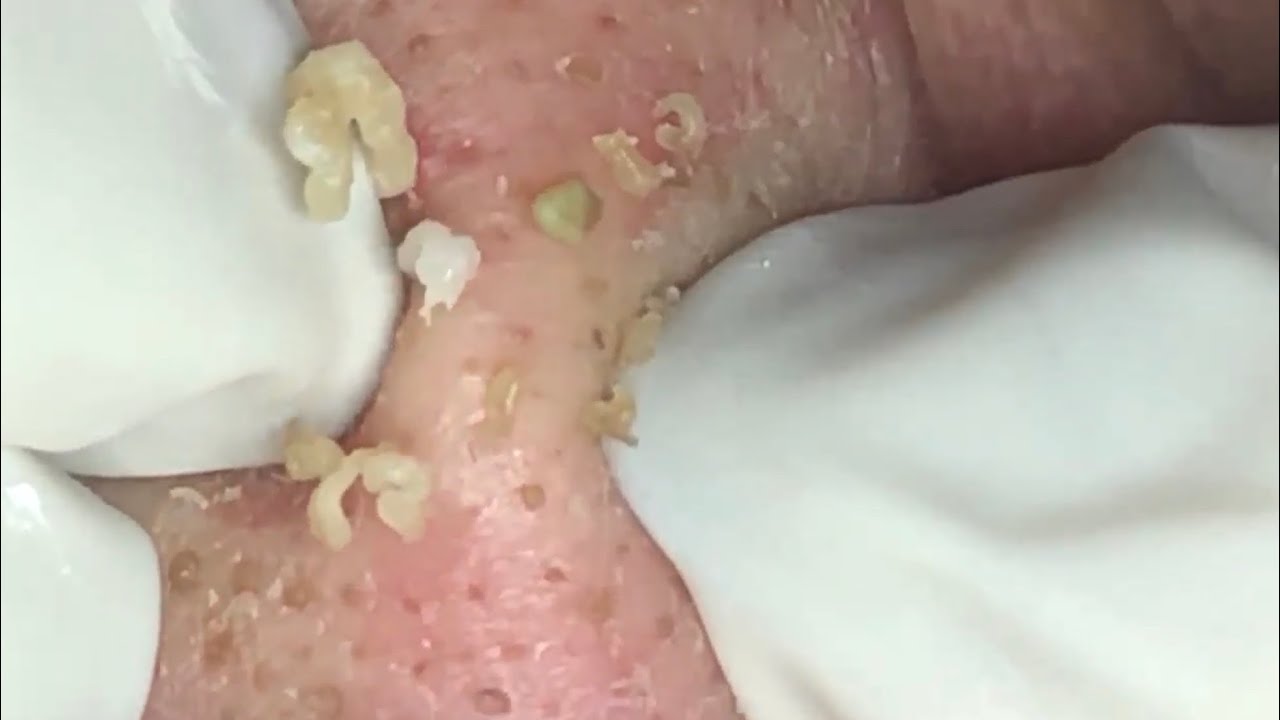 🔥 Pimple Popping 2020 Video| Super blackheads removal in nose| Blackheads extraction| Acne removal