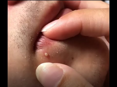 ?pimple Popping 2020 – Youtube ? How To Get Rid Of Blackheads New Video Whiteheads 72