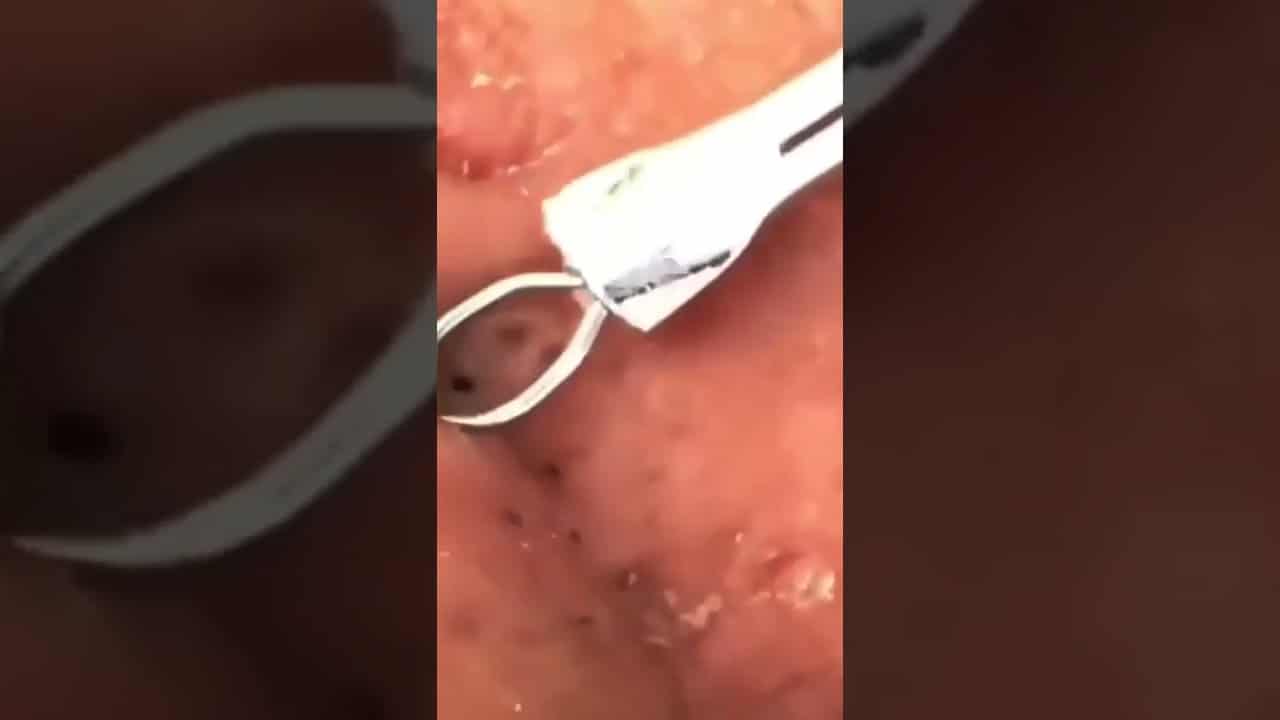 pimple popping 2022 new, blackheads on nose, pimple popping tiktok#vd34