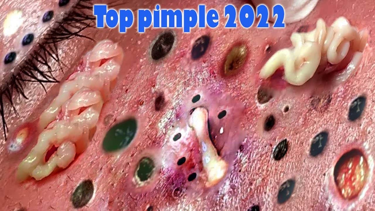 pimple popping 2022 new, blackheads on nose, pimple popping tiktok 2022#vd15