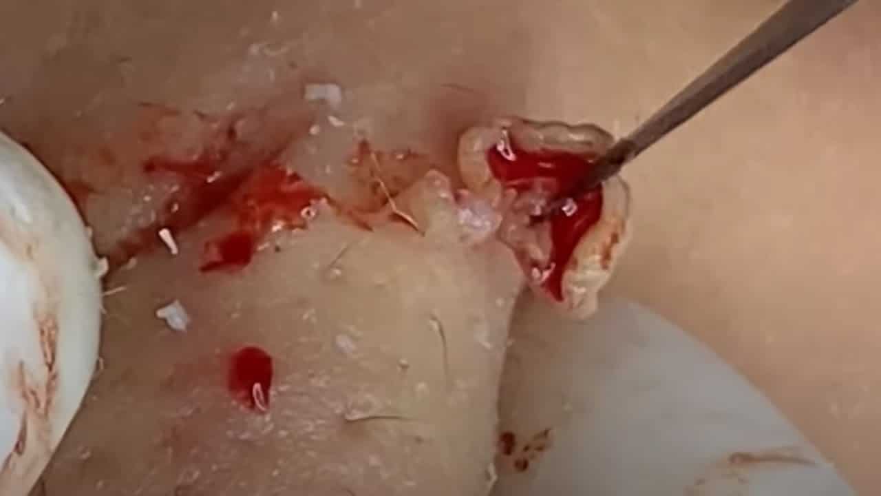 pimple popping 2022 new, blackheads on nose, pimple popping tiktok #VD8