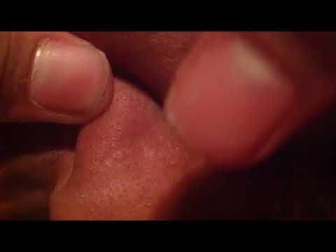 Pimple popping