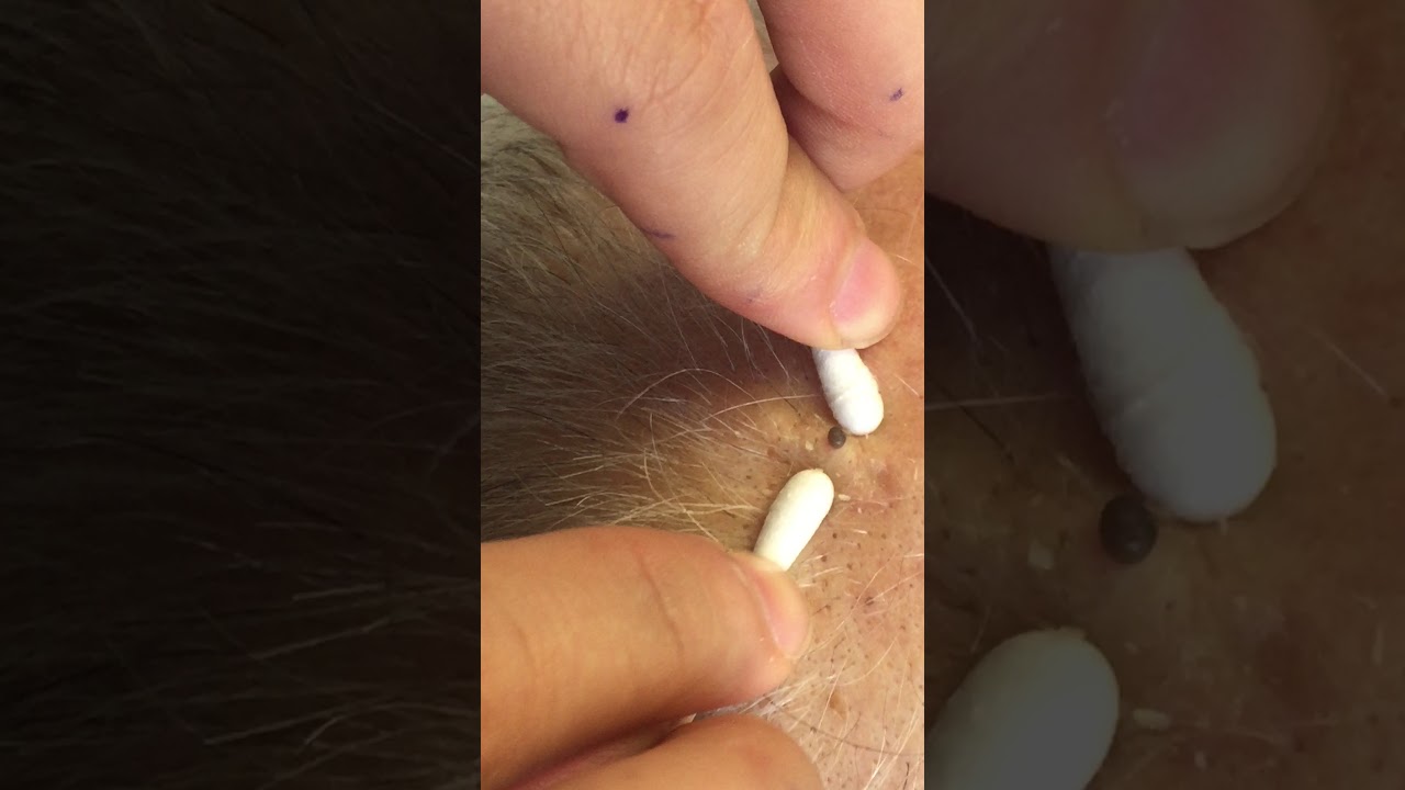 Pimple popping and acne extraction of blackhead (popping pimples in Los Angeles)