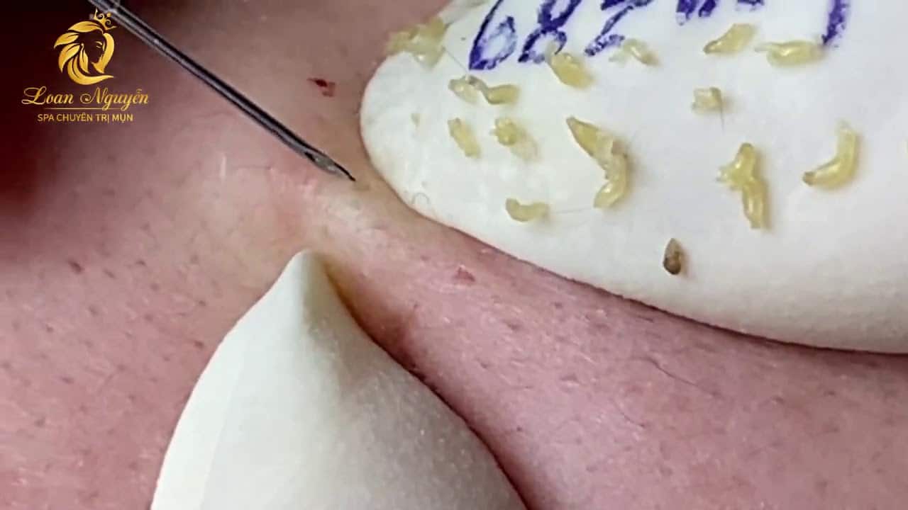 Pimple popping and blackheads extraction (389) | Loan Nguyen