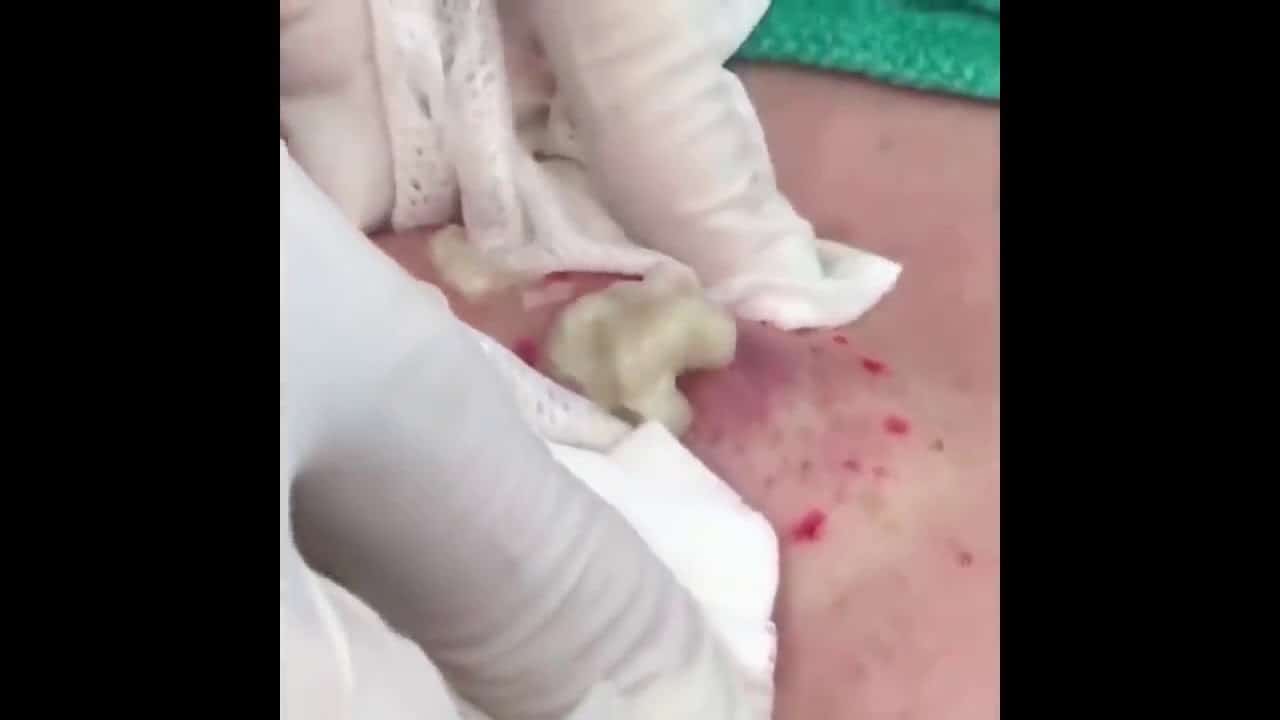 Pimple Popping! (Best)