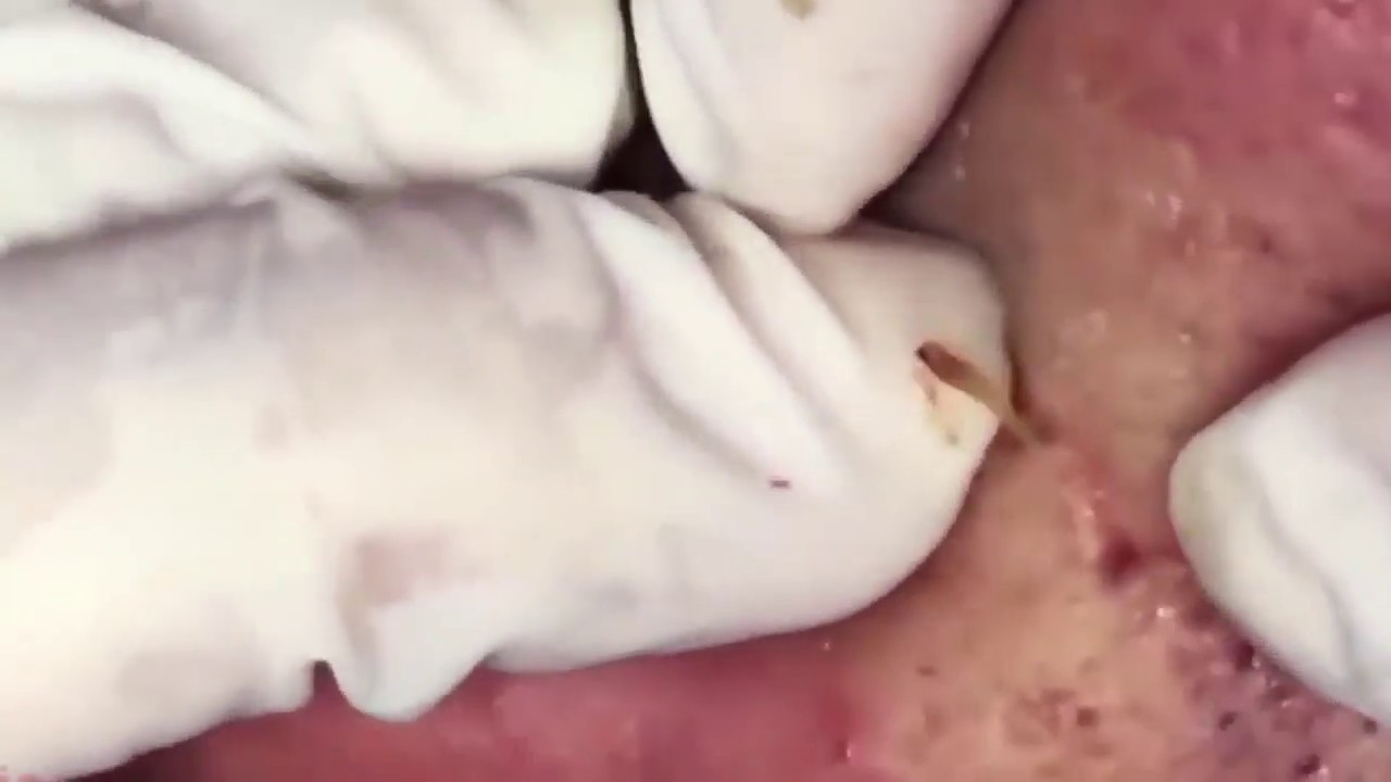 Pimple, Popping, big Blackheads, ,on The Face and around the mouth, acne 155