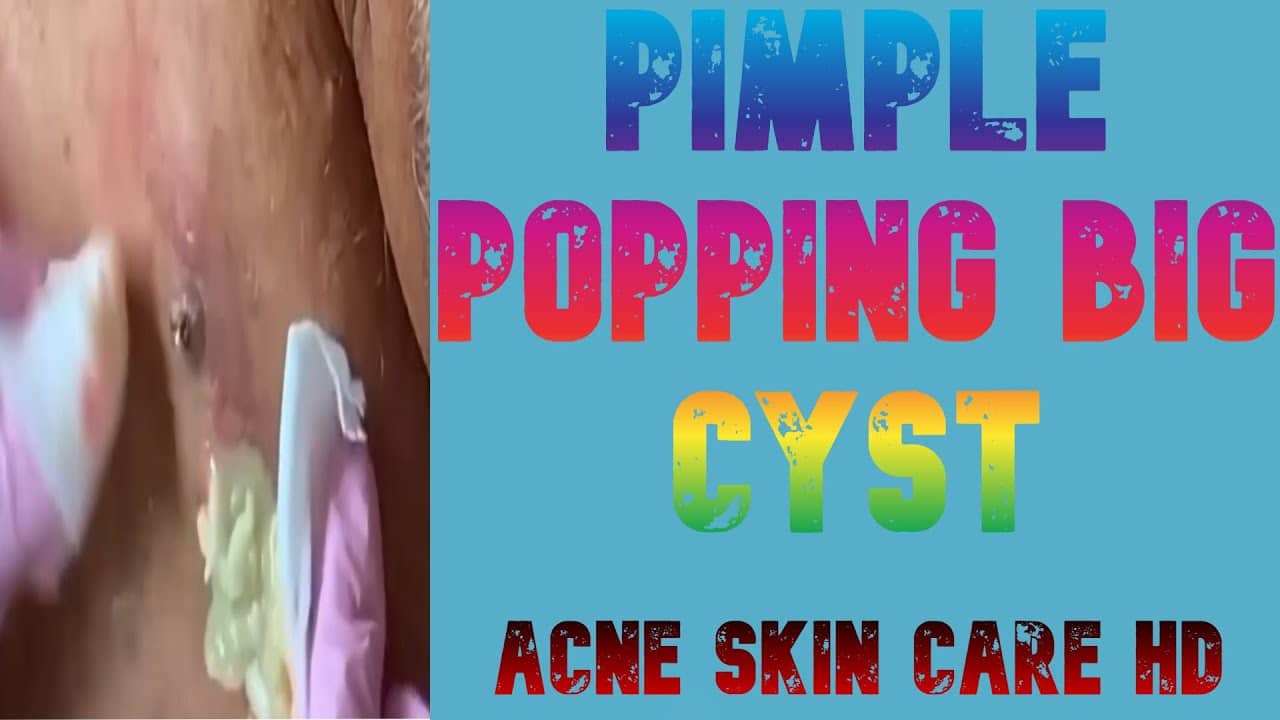 Pimple Popping Big Cyst Extraction EP16                                                     #shorts