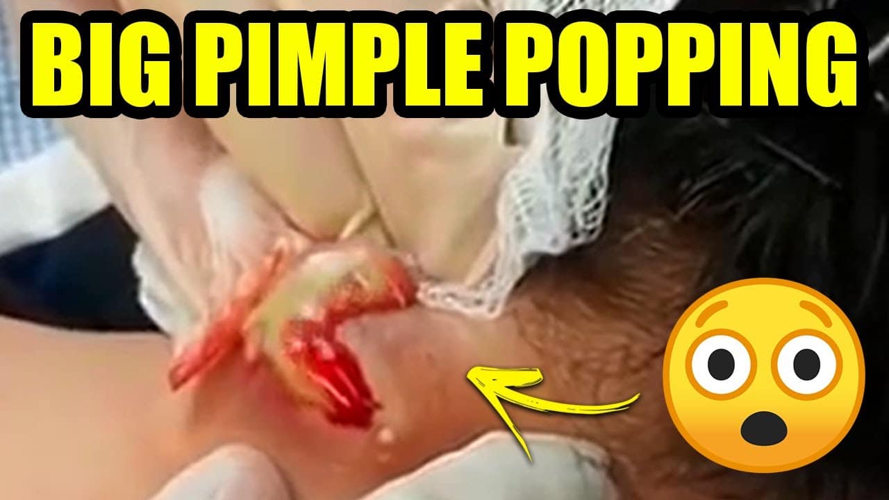 Pimple Popping: BIG N' PIMPLE POPPING – Pimple Popping Videos