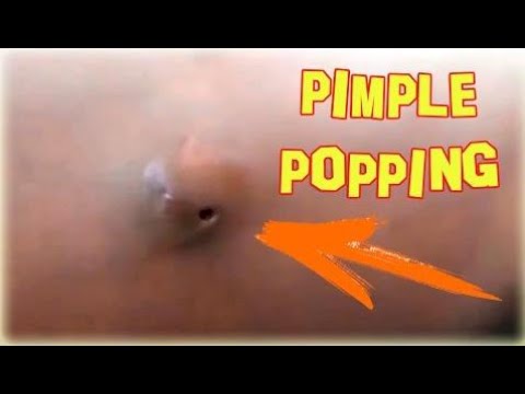 Pimple Popping.Big Zits Popping