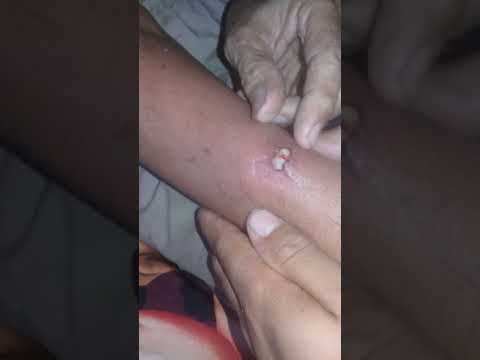 Pimple popping/bisul mantap