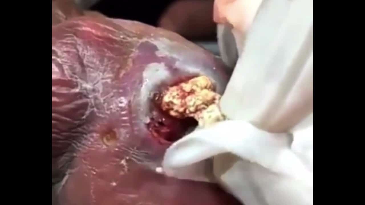 Pimple popping, blackhead and cyst extraction videos 2021|| Pimple Haven #10