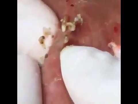 pimple popping ~ blackhead removal