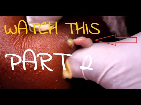 Pimple Popping Blackheads Blackheads, Whiteheads, Cysts Part 2