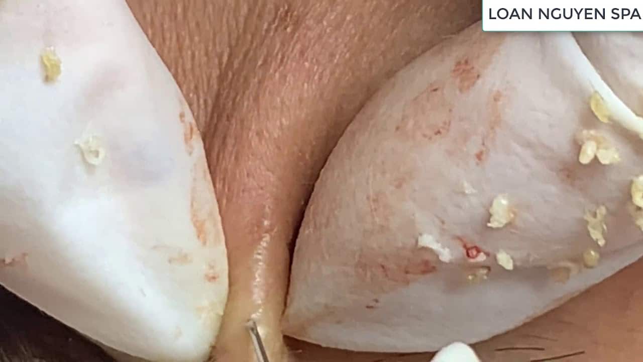 pimple popping, blackheads extraction | LOAN NGUYEN SPA