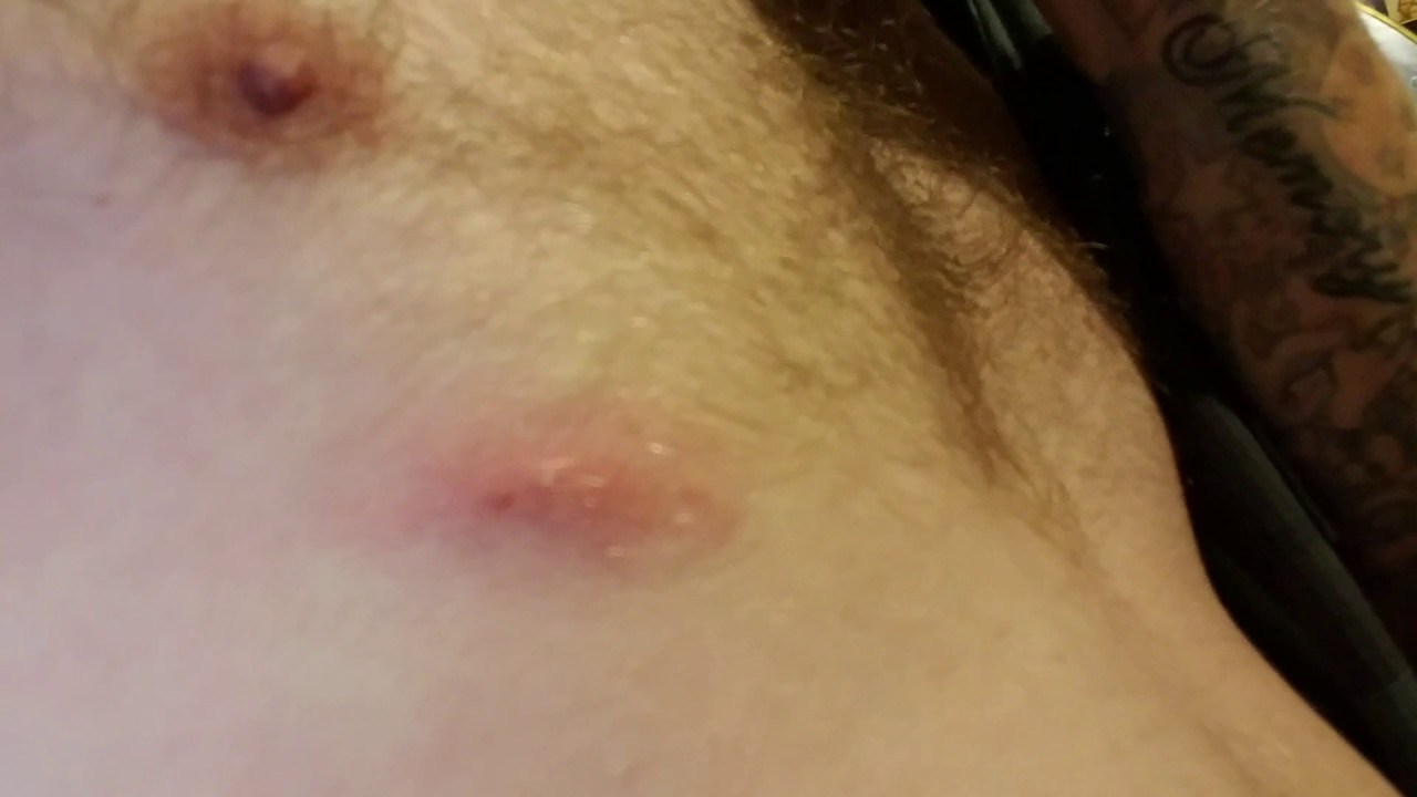 Pimple popping/blood blister pimple