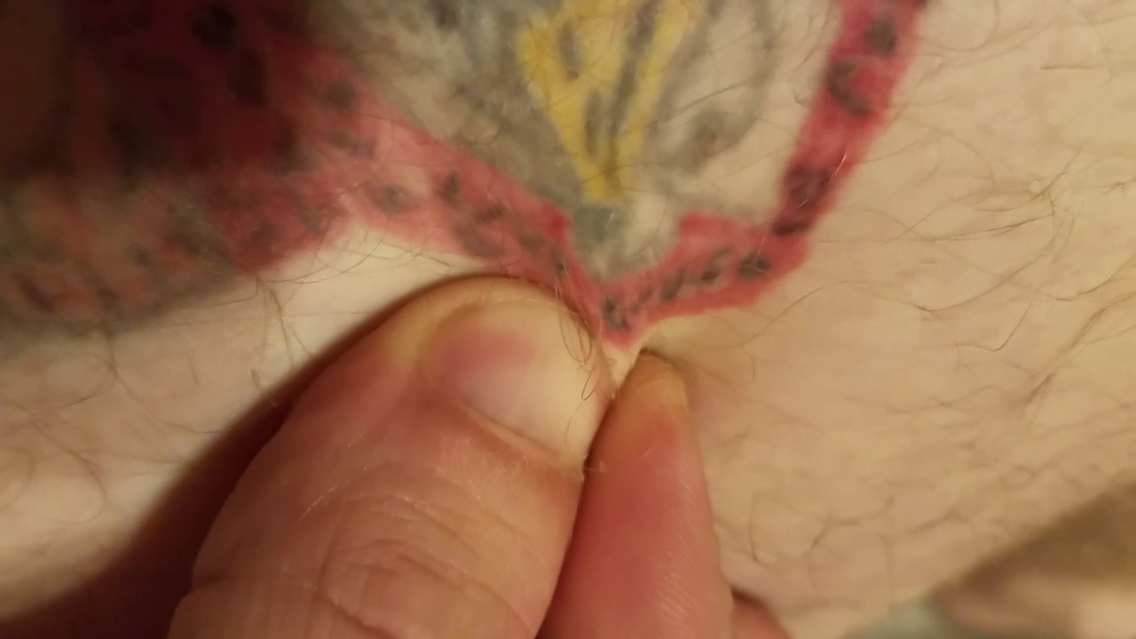 Pimple popping/ boil on thigh