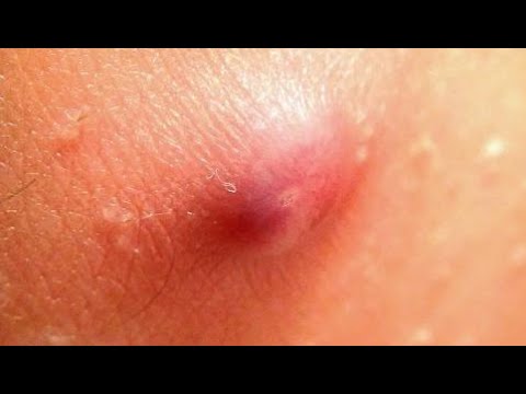 Pimple Popping Caused By Ingrown Hair