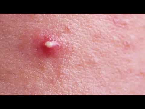 pimple popping compilation