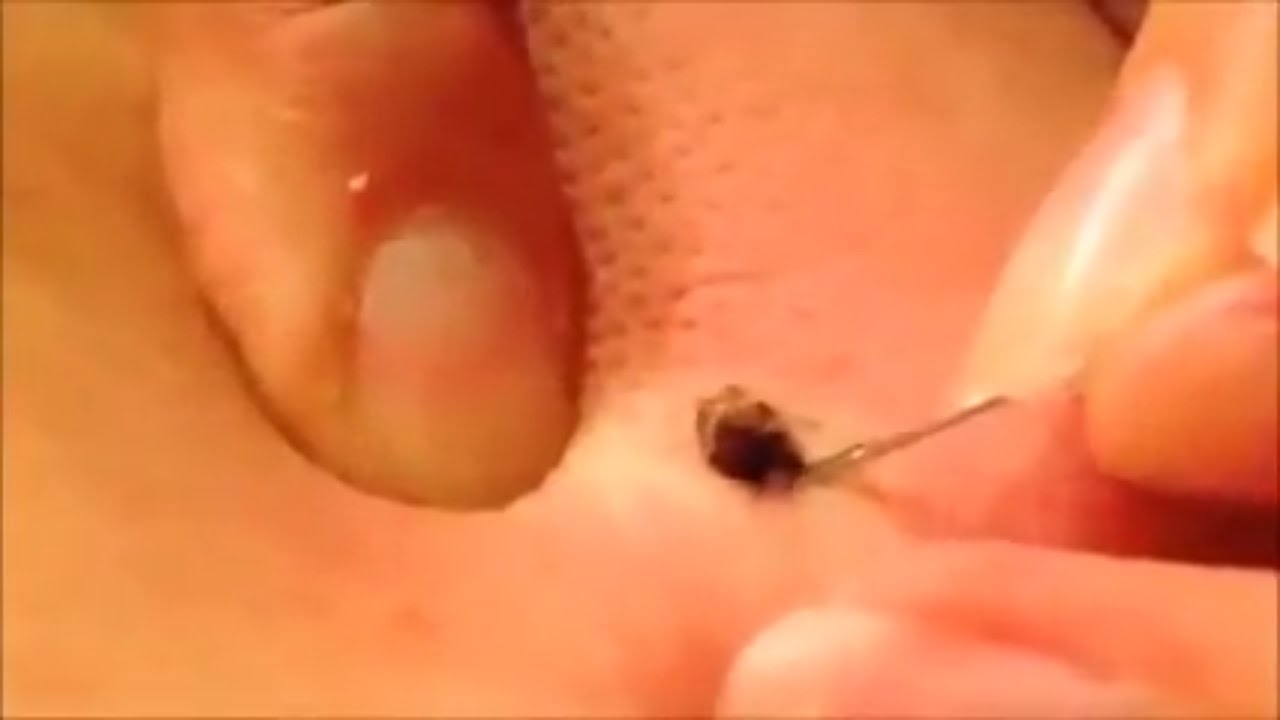Pimple Popping Compilation – Huge Pimple