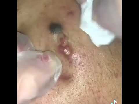 Pimple Popping Compilation Part #4