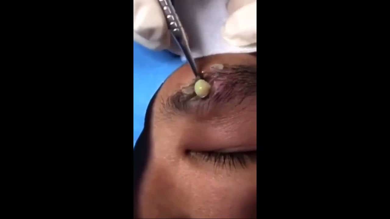 Pimple Popping Compilation Part # 22 – To Much